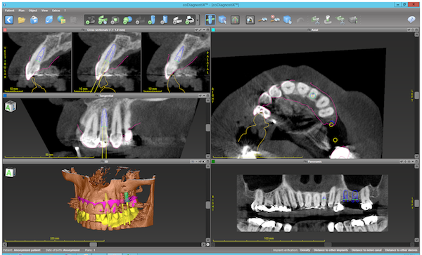 anonymized-patient-maxilla-application6